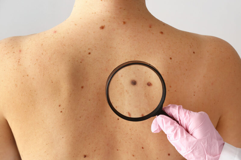 Skin Cancer Clinic Treatment Choices